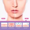Veraly 24 Parches Acne Dia/ Noche Quita Acne Espinillas Tapa