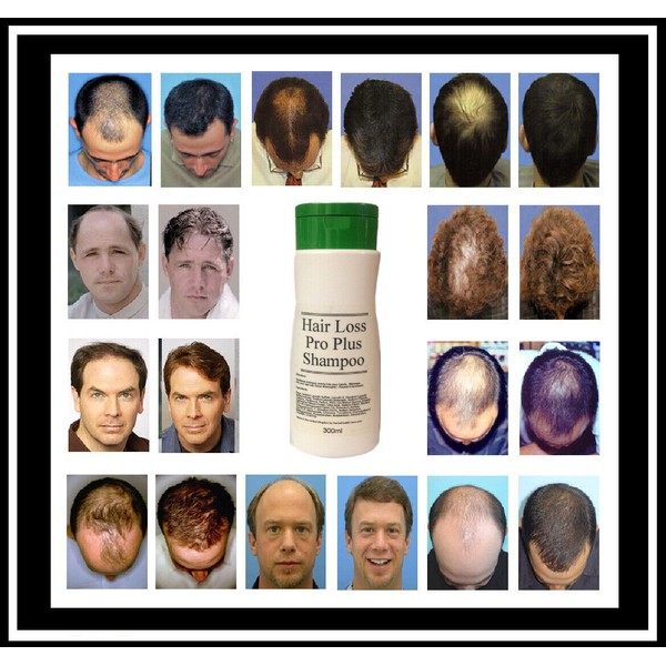 "Hair Loss Pro Plus®" STIMULATING HAIR LOSS REGROWTH SHAMPOO 300ml