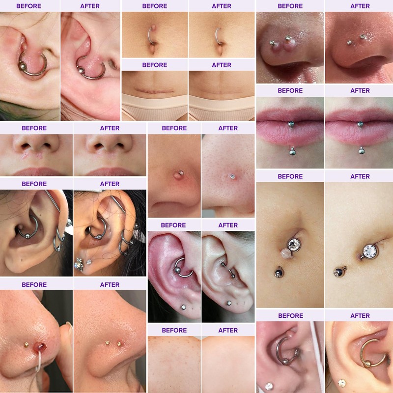 Piercing Keloid Bump Solution Kit | Piercing Aftercare Treatment with