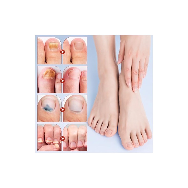 2PCS Parches De Cuidado Para Las Uñas,Parche Reparador de Uñas
