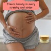 Momstead Stretchies and Stripes Stretch Mark Balm | Intense Relief