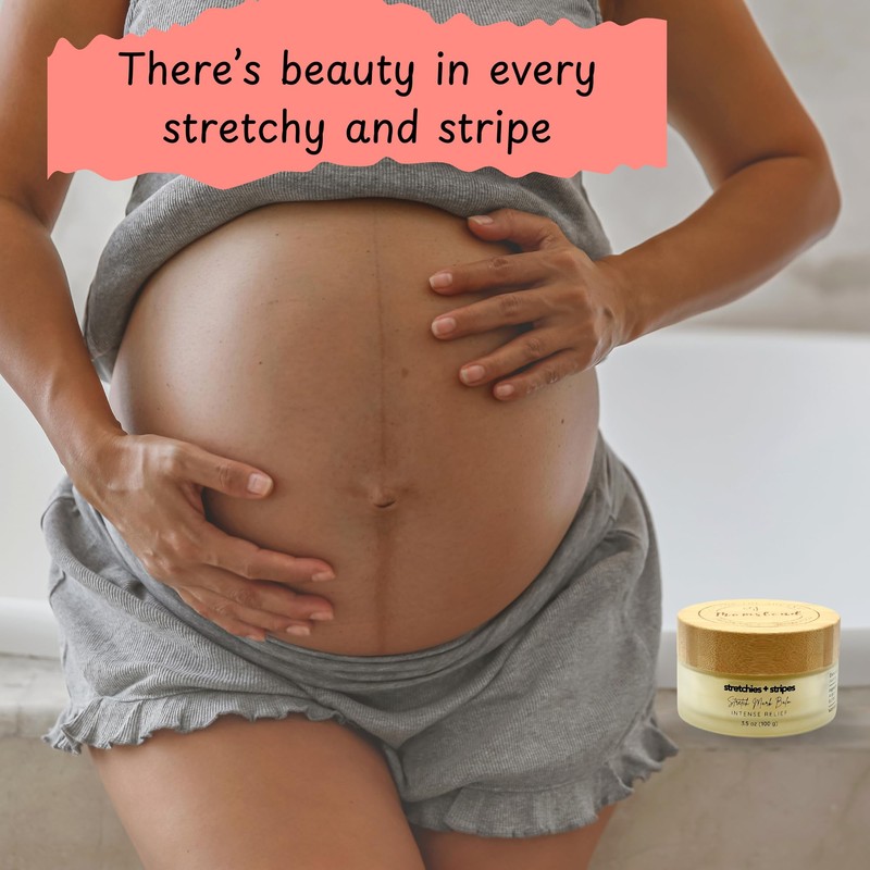 Momstead Stretchies and Stripes Stretch Mark Balm | Intense Relief
