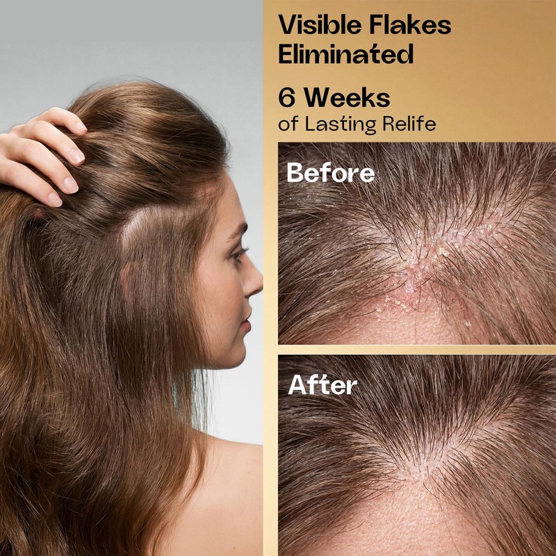 B FENG HUA Anti Dandruff Shampoo Oil & Flake Control