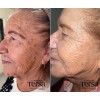 Crema Despigmentante Tersa Artesanal Vitíligo Acné Manchas FPS50 30ml