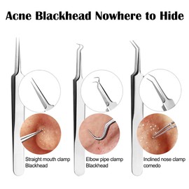 Gasea 10pcs Professional Blackhead Remover Tool Kit, Stainless Steel Pimple Comedone Extractor Tool for Whitehead Blemish Acne Curing Facial