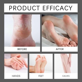Foot Cream,Foot Eczema Cream Adults,Repairing Cracked Heel and Itchy Feet,Foot Creams for Cracked Heels and Dry Skin,Foot Repair Cream,Moisturising F/oot Cream,Cra/cked H/eel Treatment