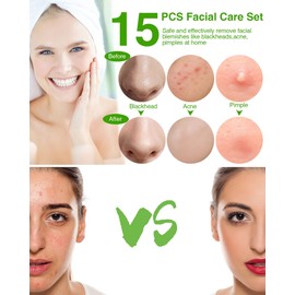 15 PCS Blackhead Remover Pimple Popper Tool Kit,Black Head Remove Extractor for Acne Comedone Whitehead Popping Zit Blemish Facial Skin Care Tools with Metal Case