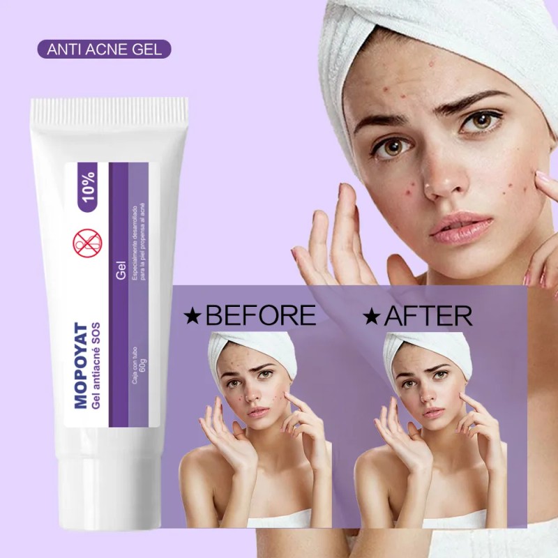 2pcs Gel Peróxido Benzoilo 10% Elimina Acné Puntos Negros Acneica