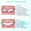 Custom Partial Dentures for Missing Teeth, Removable Dentures for Teeth,