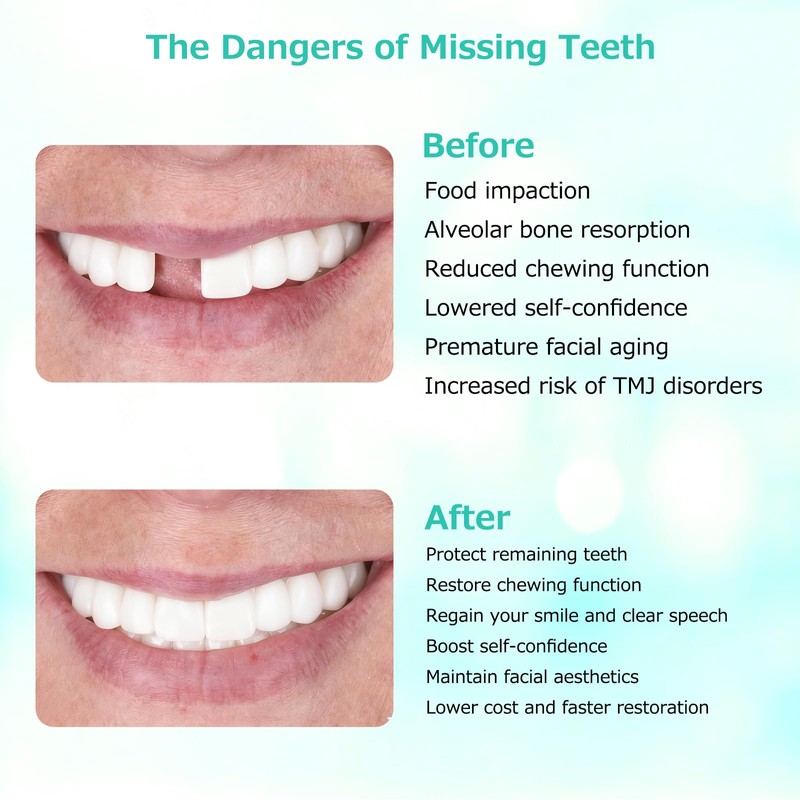 Custom Partial Dentures for Missing Teeth, Removable Dentures for Teeth,