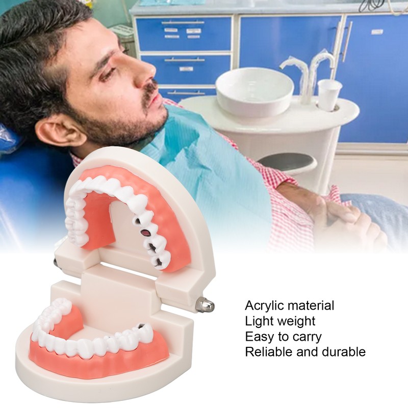 Dental Disease Caries Teeth Model Resin Simulation Teaching Prop Dental