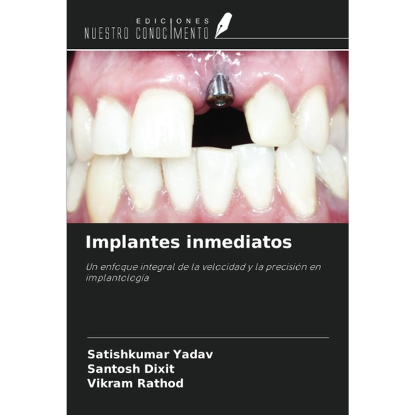 Implantes inmediatos: Un enfoque integral de la velocidad y la