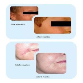 Dermatix Reductor De Cicatrices Advanced Scar Reducer 15g