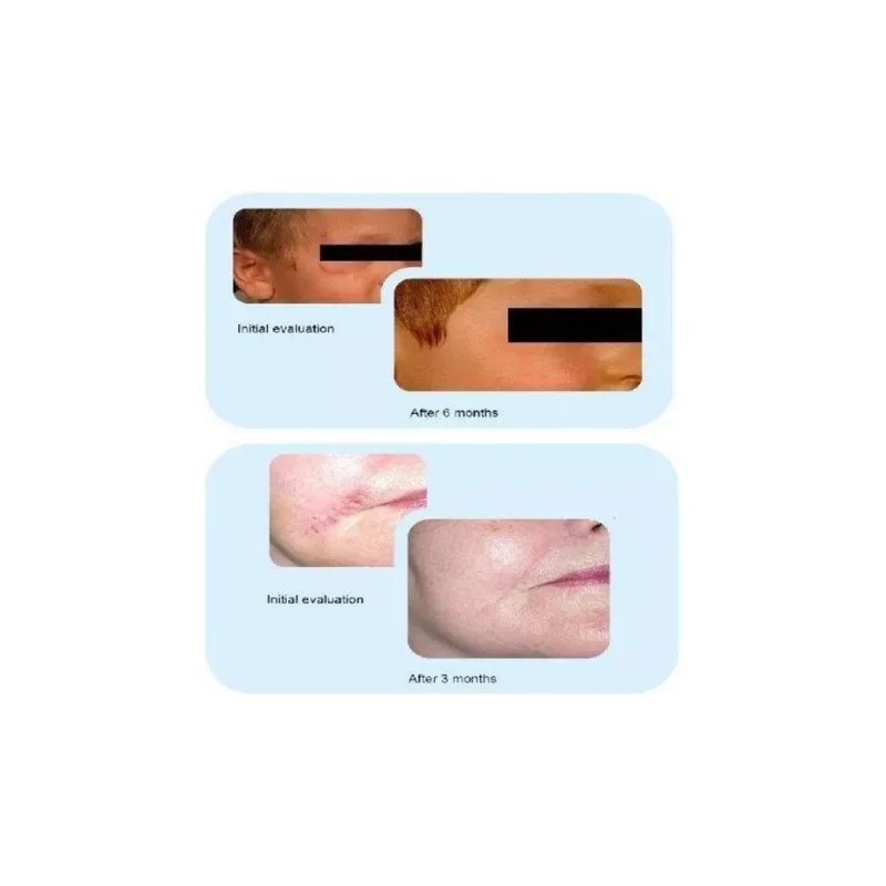 Dermatix Reductor De Cicatrices Advanced Scar Reducer 15g