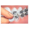 Orthowax - Cera de ortodoncia para usuarios de aparatos ortopédicos,