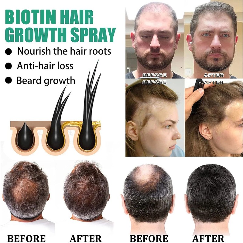 탈모 치료/머릿결개선/모발 강인화, 20ml, 1개 Hair Loss Treatment / Hair