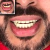 Instant Smile Comfort Fit Flex Teeth - Upper and Lower