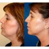 Dtup Kit Reduce Papada Define Mandibula Guasha + Gel +