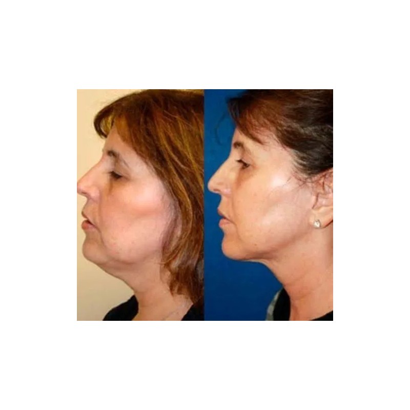 Dtup Kit Reduce Papada Define Mandibula Guasha + Gel +