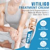 Biqyu Vitiligo Treatment Cream, Effective Vitiligo Treatment, Improve Skin Pigmentation,