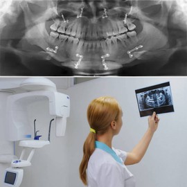 Soportes de posicionador de rayos X Dentales, accesorios para asistentes FPS 3000, se pueden utilizar para todos los sistemas de posicionamiento de película introral, kits completos de práctica de estudiantes dentales