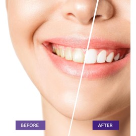 Purple Toothpaste for Teeth Whitening, Purple Teeth Whitening Toothpaste, Purple Whitening Toothpaste for Adults, Teeth Whitening Purple Toothpaste, Teeth Whitening Purple 30ml