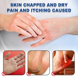 42% Urea Cream Moisturizing Stick for Cracked Heels & Hands and Dry Skin & Callus Remover, Effective Foot Lotion, Repairs Knees & Elbows