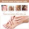 Ingrown Toenails Set, Toenail Correction, Toenail Patch, Toenail Correction Patch,