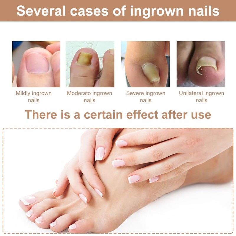 Ingrown Toenails Set, Toenail Correction, Toenail Patch, Toenail Correction Patch,