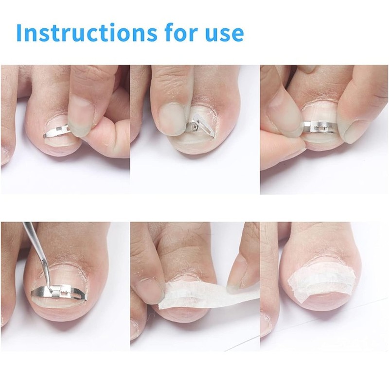 1pc Silver Ingrown Toenail Correction 17 to 22mm Adjustable Stainless