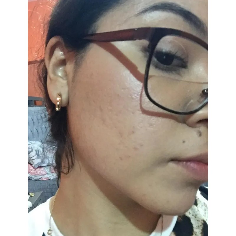 Crema Despigmentante De Paño Melasma Acne