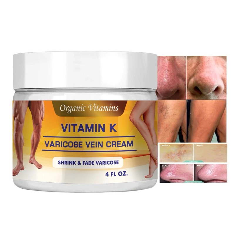 Vitamin K Cream Spider Varicose Veins Scars Rosacea Capillaries Dark
