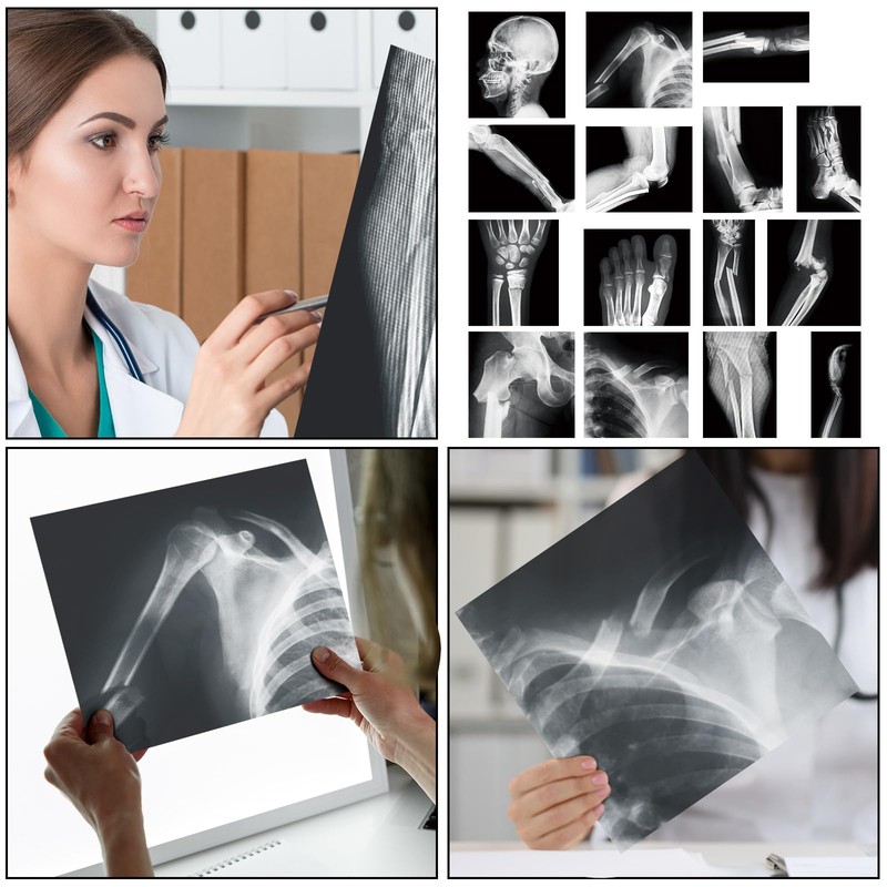 Sayglossy 15 Pcs Broken Bones X Ray Set Human X