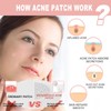 Microdart Pimple Patch - Acne Patches - Spot Patches with
