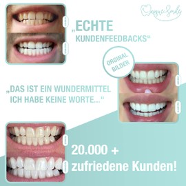 UniqueSmile High-Quality Teeth Whitening Kit, All-in-One Bundle for Teeth Brightening and White Teeth, Teeth Bleaching Set blue