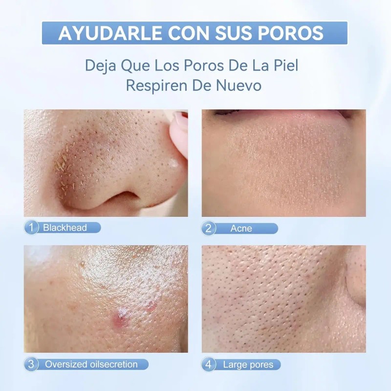 Exfoliador De Piel Anlan Ultrasónica Con Luz Roja Y Azul