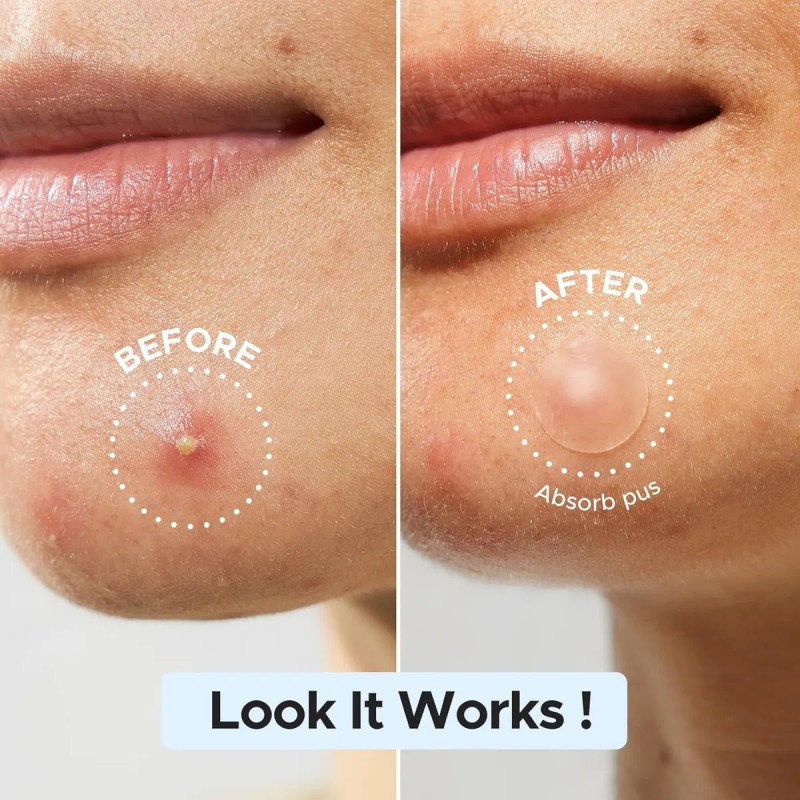 Litbear Parche De Espinillas A Granel, 480 Parches De 3