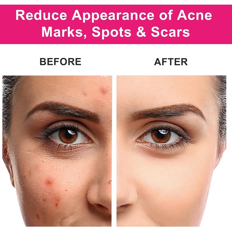 Aceite de semilla de rosa mosqueta 100% puro y natural