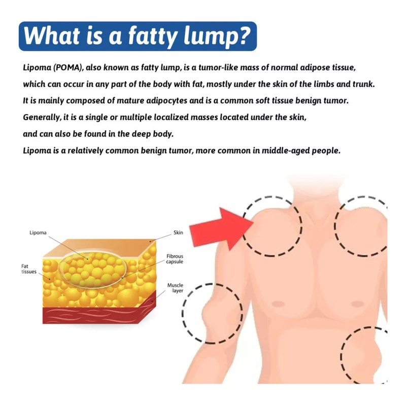 Generic 2× Crema De Eliminación De Lipomas Q Lipoma Cleaning