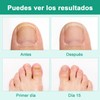 2 Piezas Krassentiales Líquido Reparador de Uñas de Los Pies,
