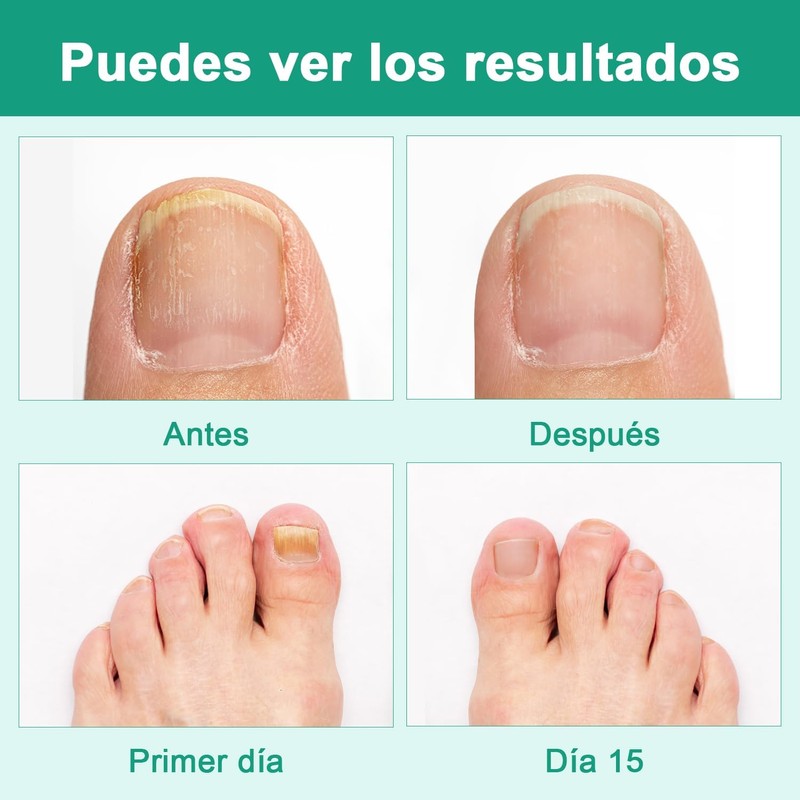 2 Piezas Krassentiales Líquido Reparador de Uñas de Los Pies,