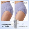 Butt & Thigh Acne Cream – Fast Acting Exfoliating Body