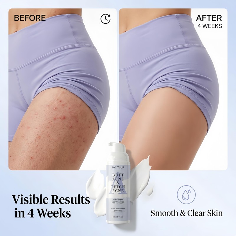 Butt & Thigh Acne Cream – Fast Acting Exfoliating Body