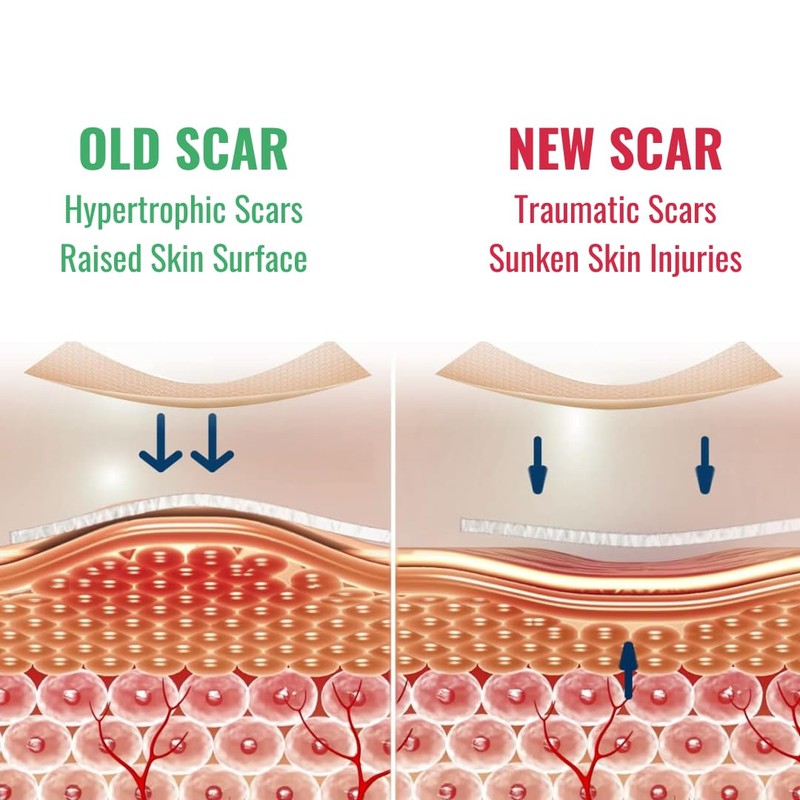 NIEGON Professional Silicone Scar Tape (1.6" x 60") - Scar