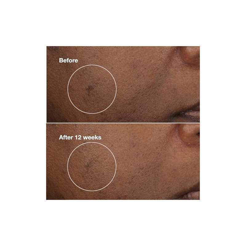 Clinique Even Better Clinical Brightening Moisturizer With Salicylic Acid, Glucosamine
