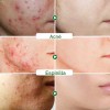 Crema Limpieza Facial Ácido Salicílico
