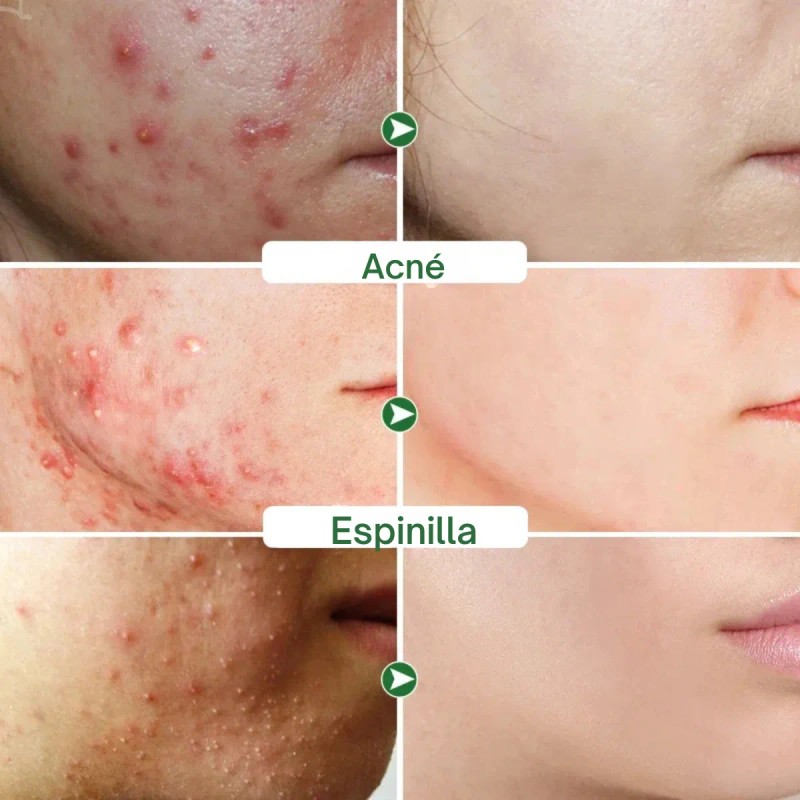 Crema Limpieza Facial Ácido Salicílico
