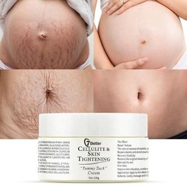 Crema Remoción de Estrías y Cicatrices para El Embarazo - Reparación de Cicatrices, Reafirmante Abdominal, y Suave Erradicación de Estrías Cuidado de La Piel Cuerpo