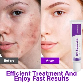 2pcs Azelaic Acid 12% Facial Serum,Azelaic Acid Serum Cream,Azelaic Acid Serum Face Cream,Skin Brightening Acid,Hydrating Serum,Brightening Face Skin Care Treatment for All Skin Types