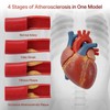 Simedutech Atherosclerosis Model, Artery Plaque Display,Vascular Disease